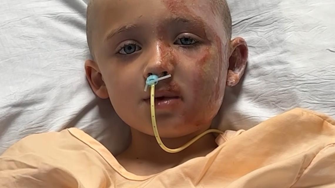 6-year-old boy, grandmother severely burned by downed power line ...