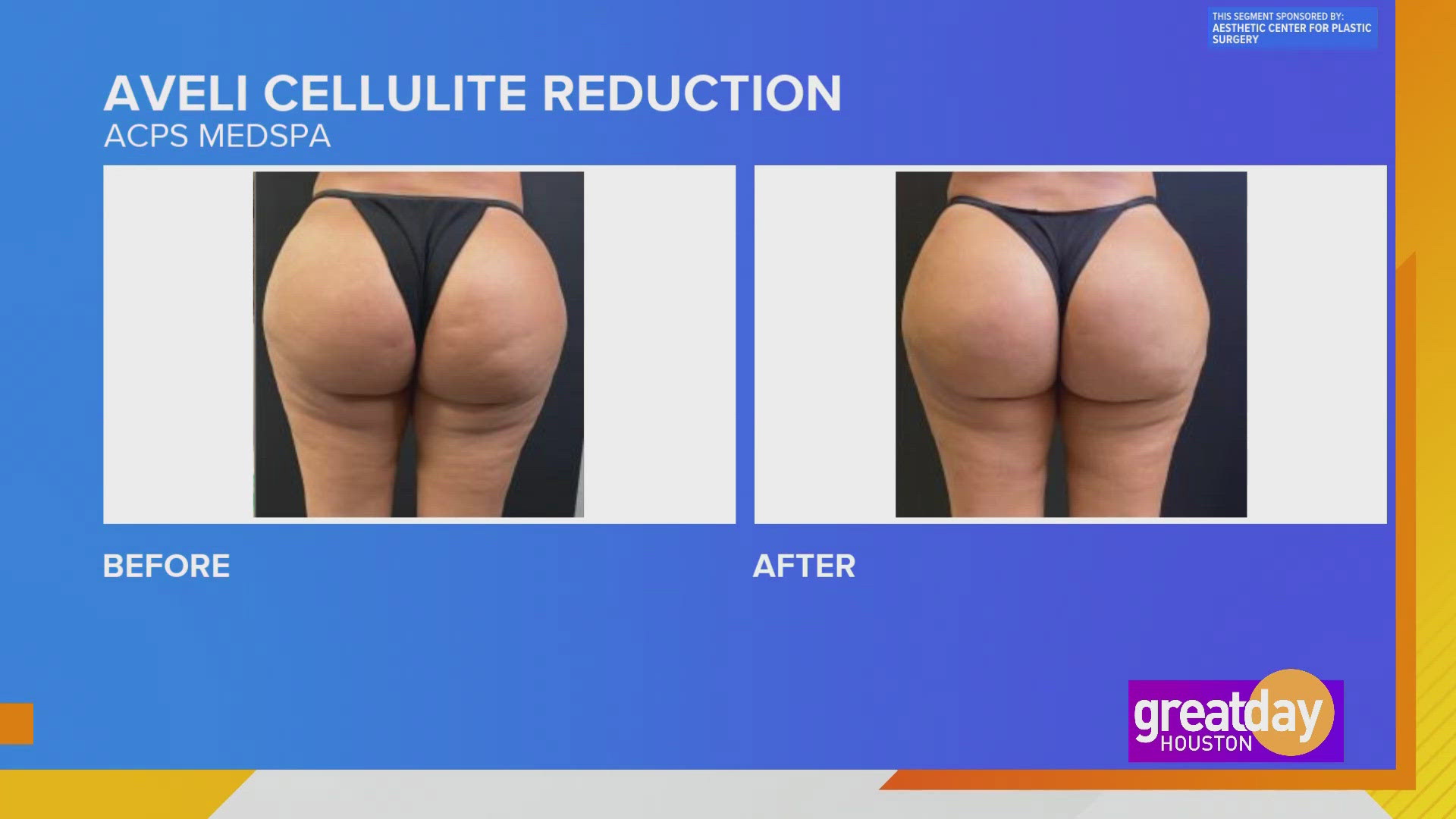 Cellulite isn't a health risk, but it can impact self-esteem 