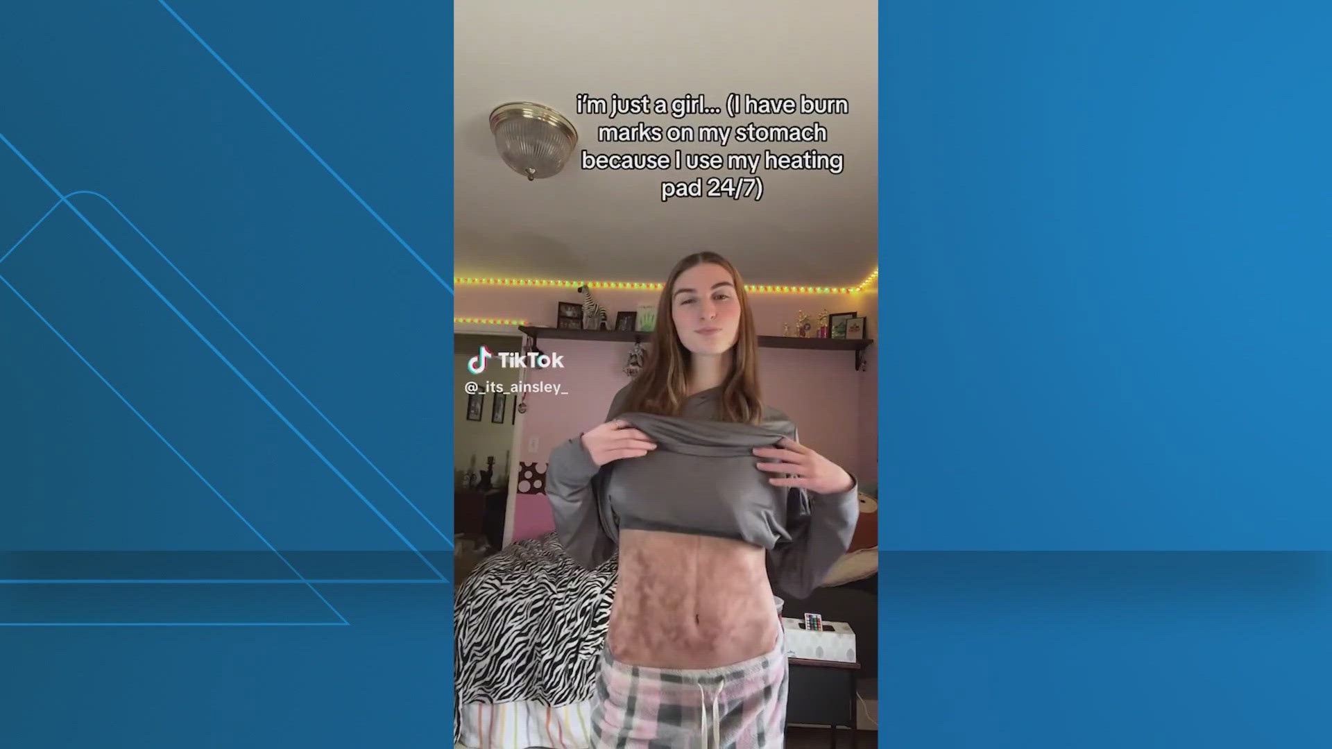 What is ‘Toasted Skin Syndrome?’ | Experts explain the net-like skin ...