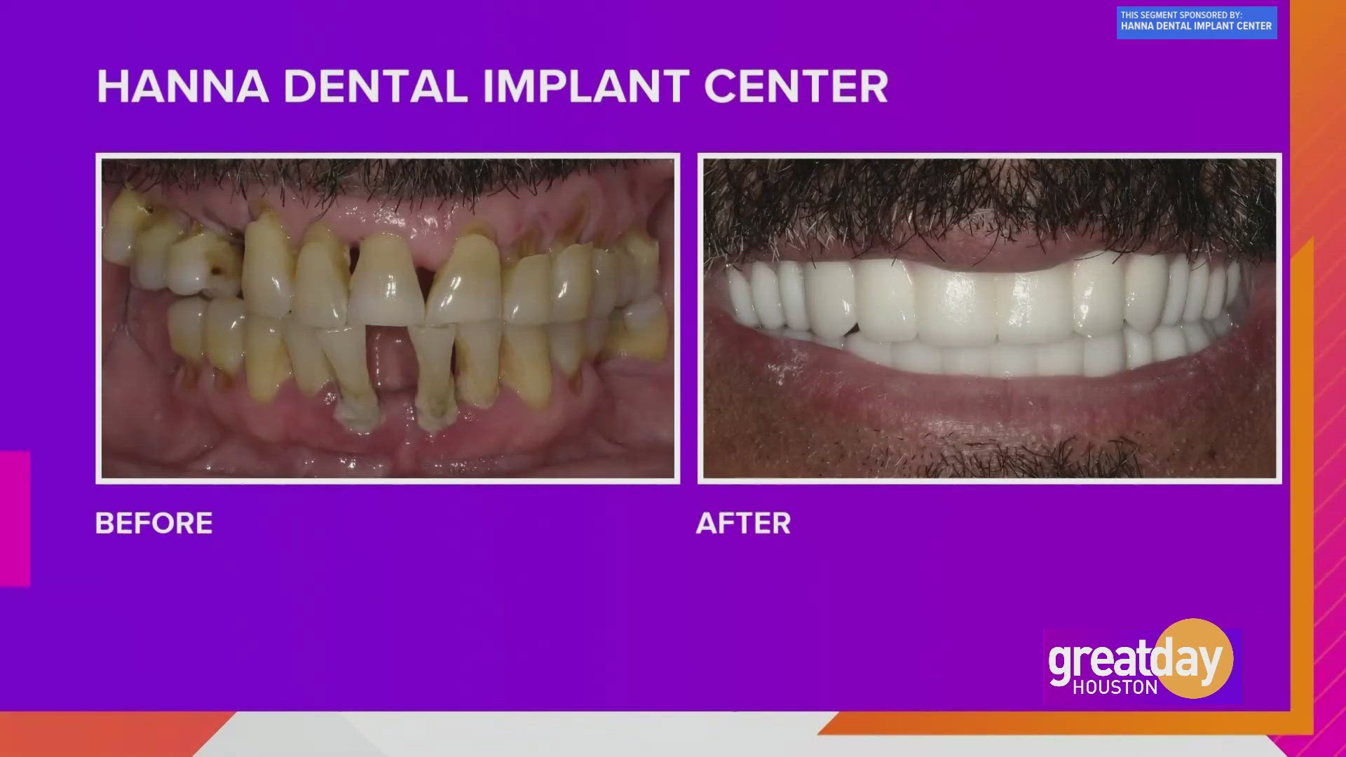 Dr. Raouf Hanna offers full mouth makeovers for permanent solutions