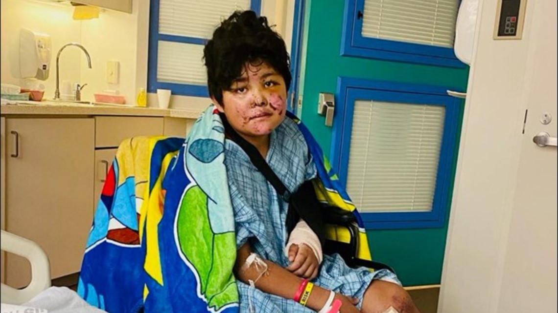 Bocah 12 tahun terluka parah saat tabrak lari, kata keluarga