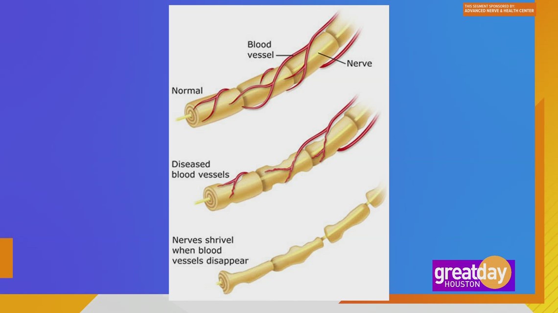 Bagaimana menemukan kelegaan dari neuropati dengan Advanced Nerve and Health Center