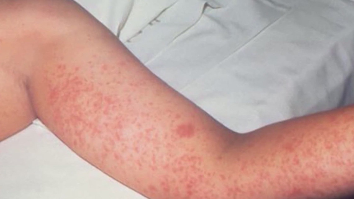West Texas measles outbreak ends, state health officials say | khou.com