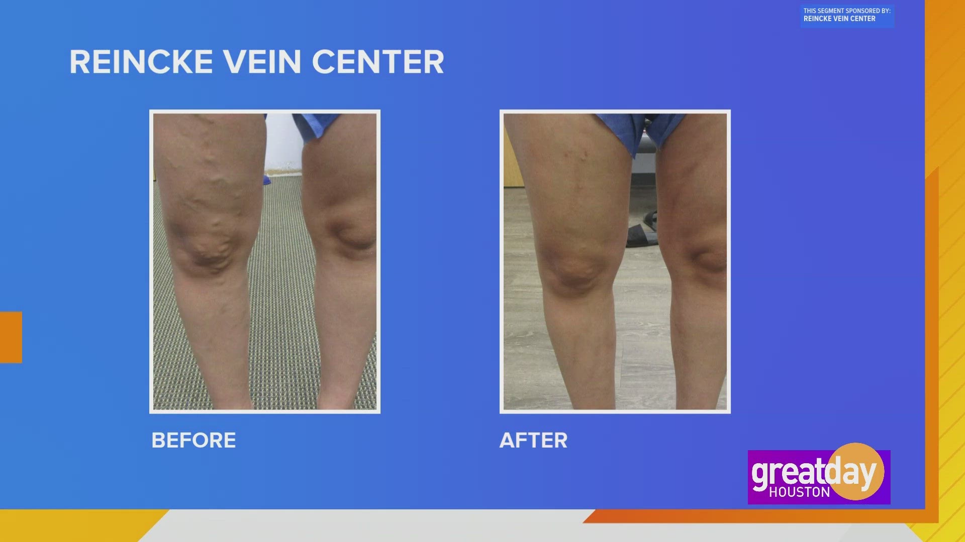 Minimally invasive, non-surgical vein treatments that help get patients back on their feet in no-time.