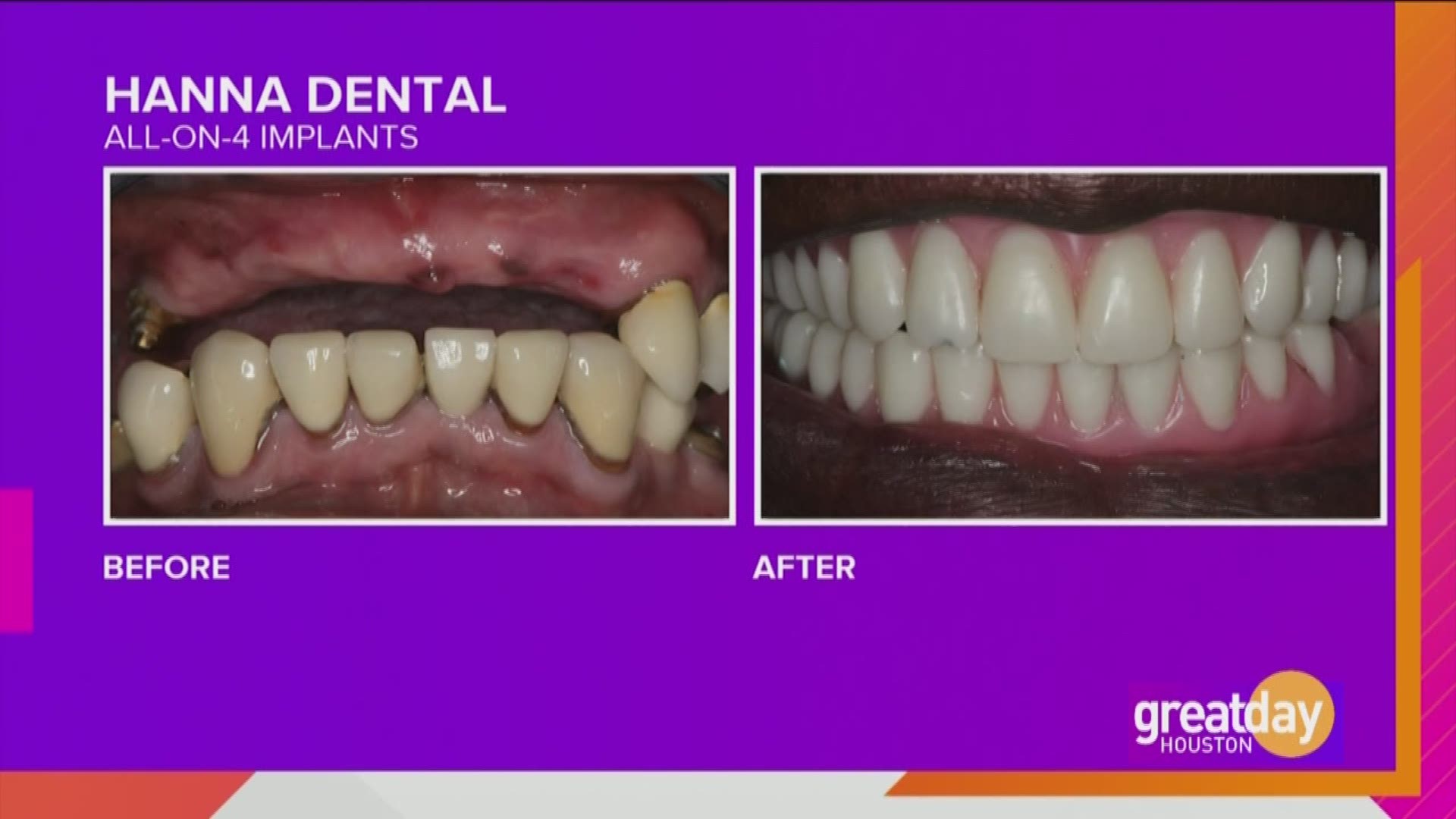 Hanna Dental Implant Center helped Cristina Martinez get her smile back