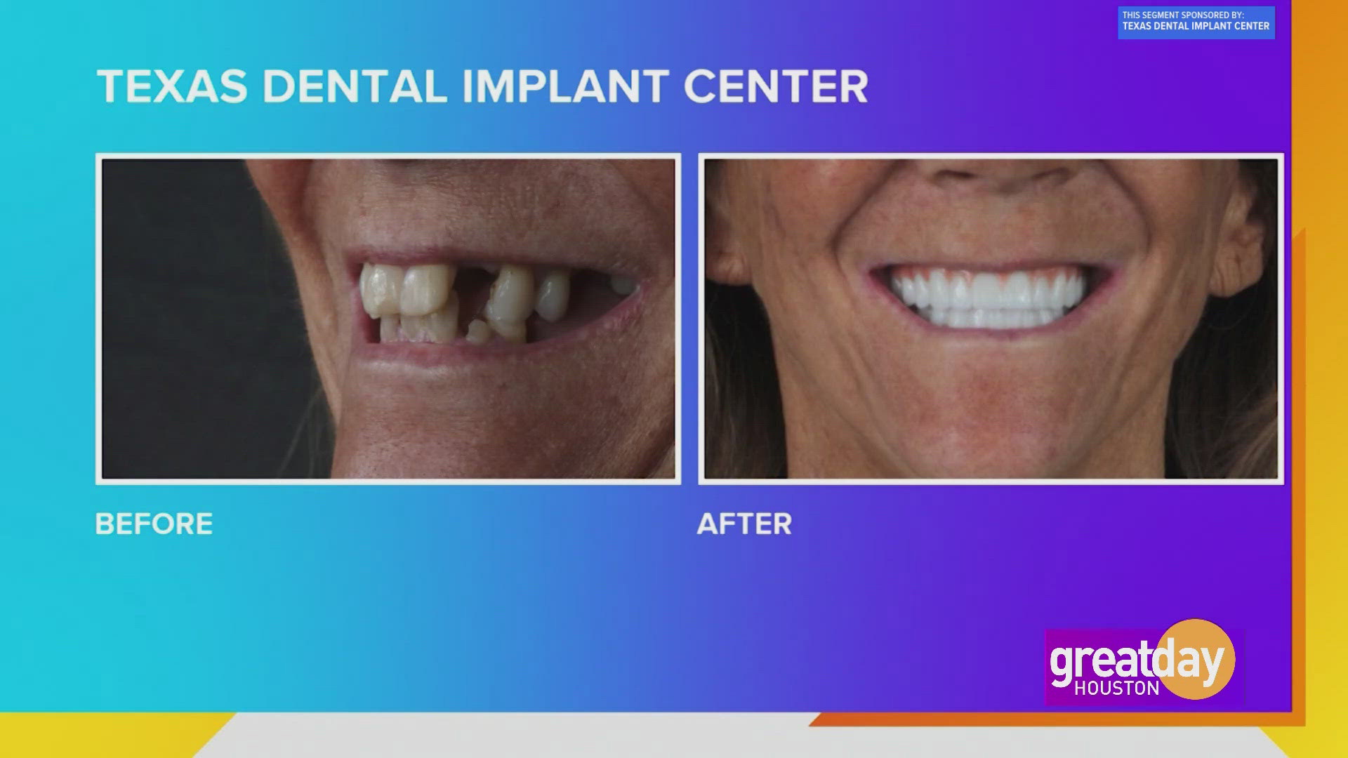 The Texas Dental Implant Center can give you the smile of your dreams.