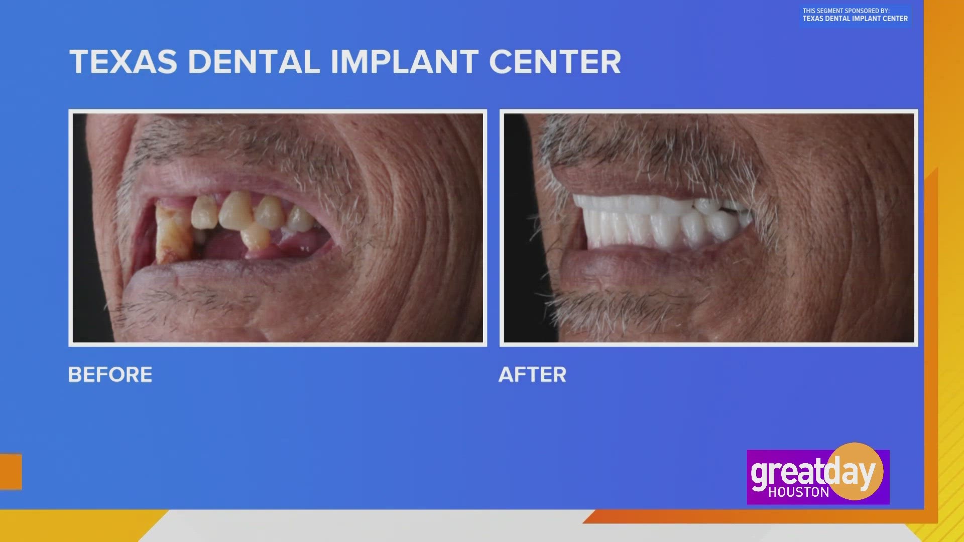 No more mean-mugging to hide what's behind your smile. Dr. Michel Azer with the Texas Dental Implant Center, shares how he helps your confidence through your smile!