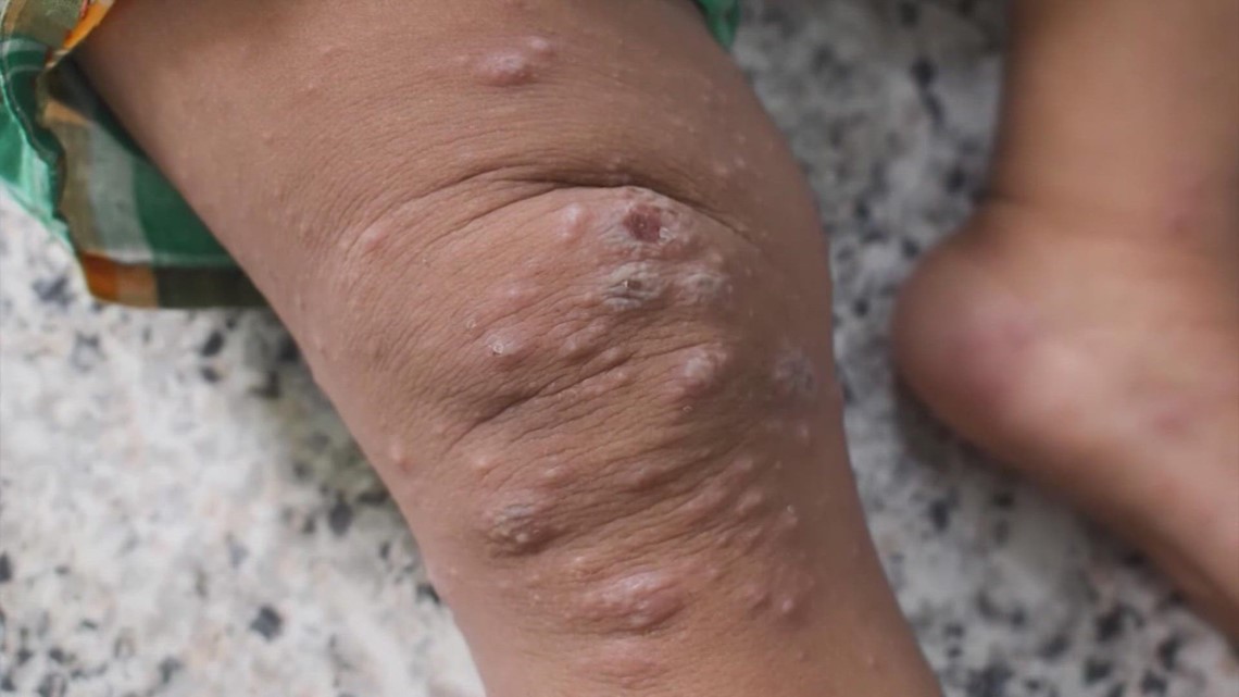 What we know about the first pediatric case of monkeypox in Texas