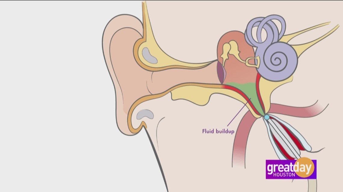 Longlasting solution to constant plugged ears