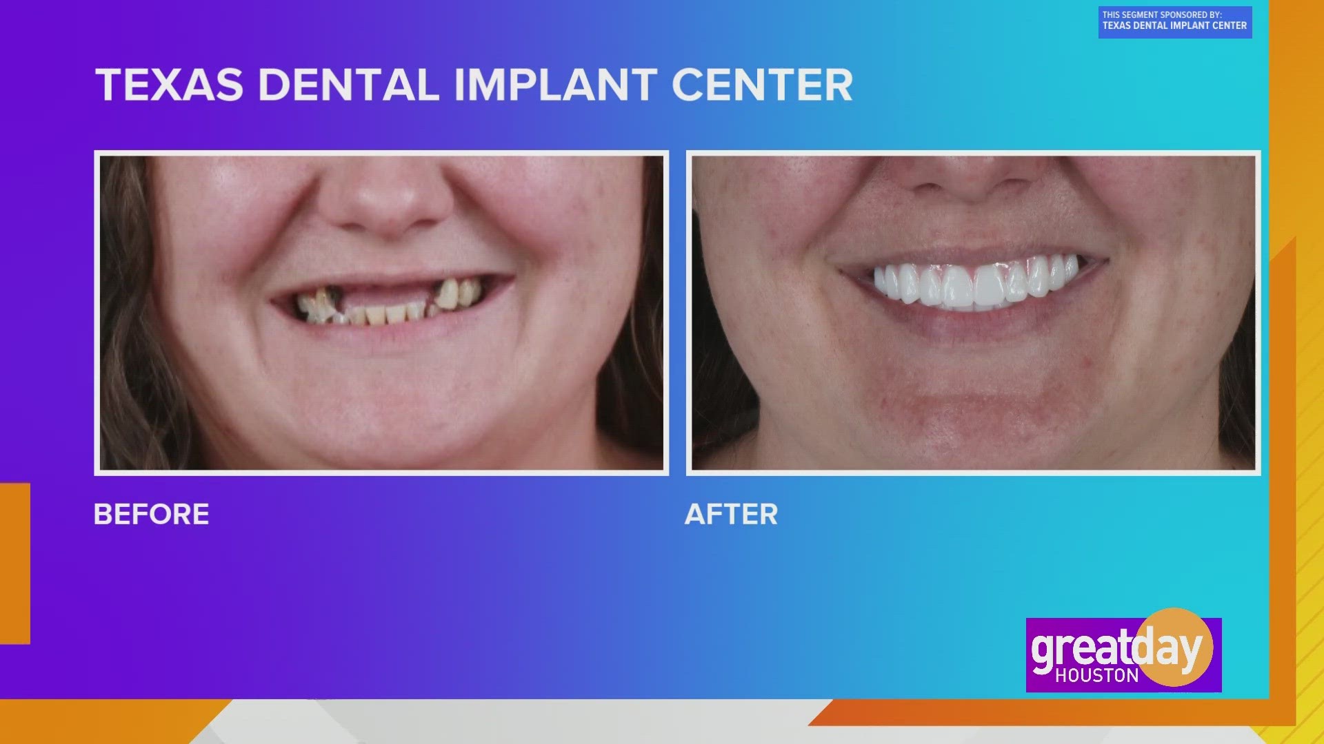 Gone are the days of covering your mouth to hide your smile! Texas Dental Implant Center can transform your confidence through your smile!