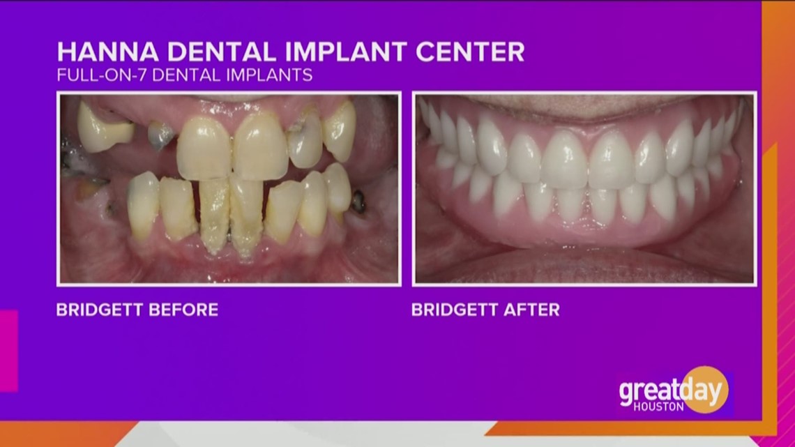 Michael was all smiles after visiting Hanna Dental Implant Center