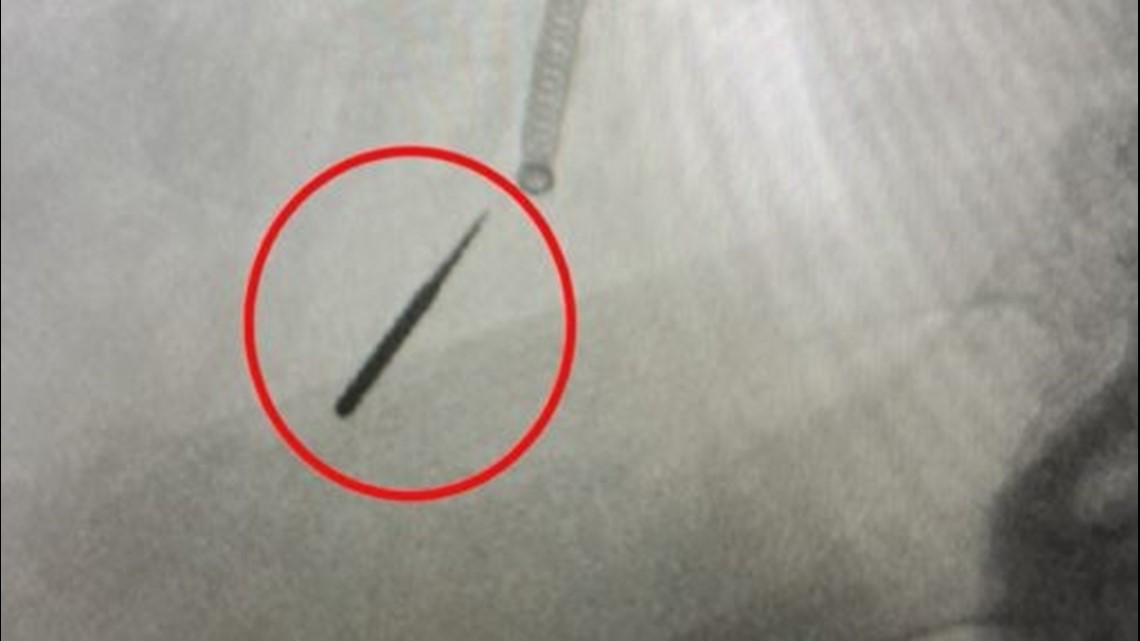 Man swallows dental drill bit during tooth filling procedure