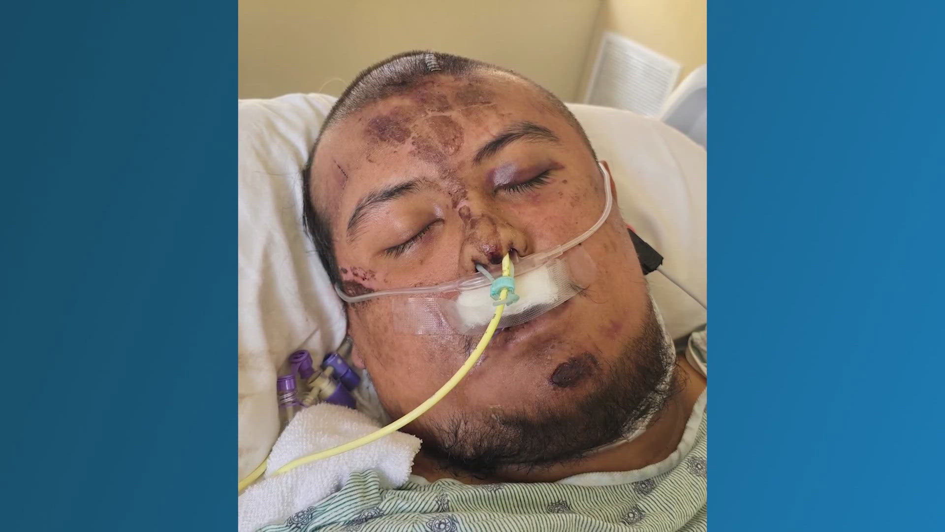 A boy has been hospitalized for weeks after suffering severe injuries in an ATV accident on May 17 in northeast Harris County. It happened on Hirsch Road.