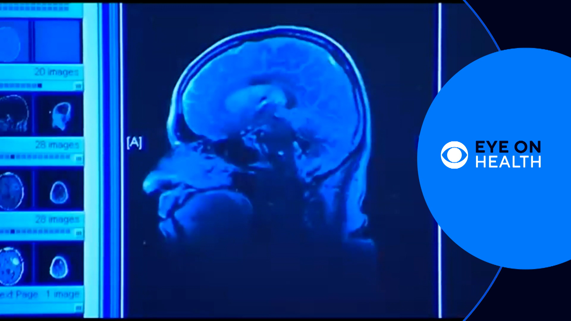 In this episode of Eye on Health, we discuss various topics such as lead in cinnamon products, fighting cancer, and more.