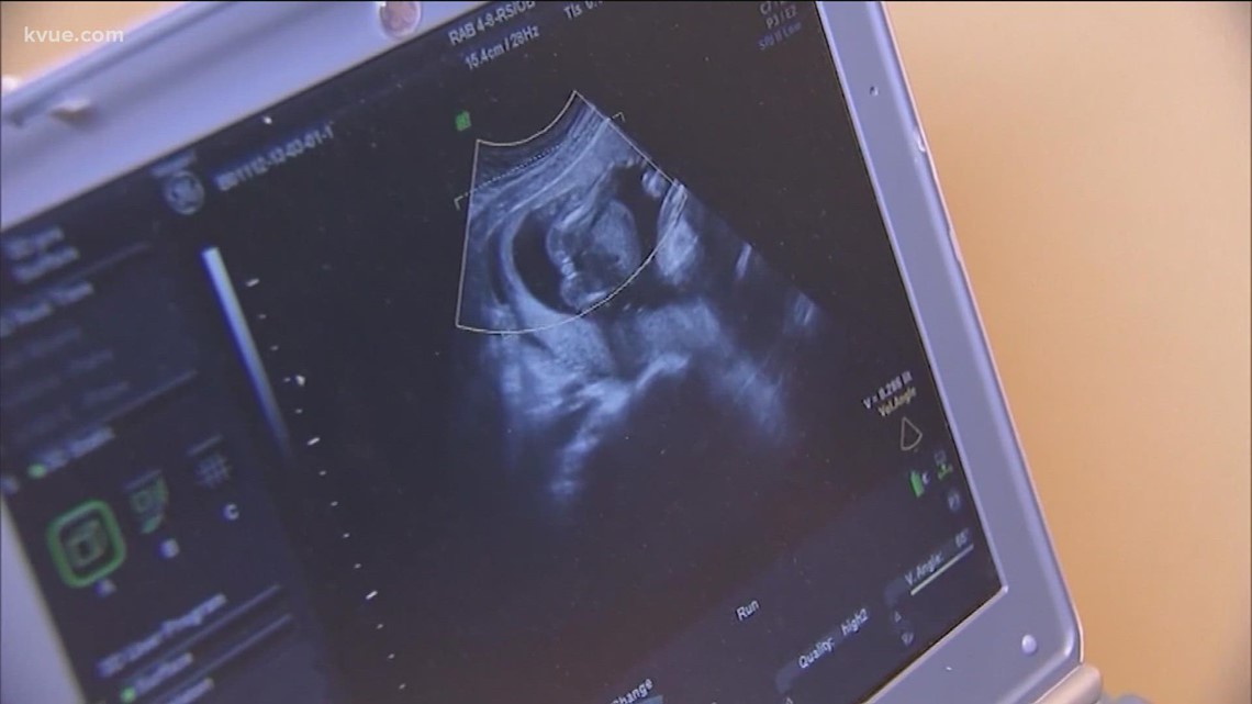 Setelah larangan enam minggu, orang Texas pergi ke luar negara bagian untuk melakukan aborsi, catatan baru menunjukkan