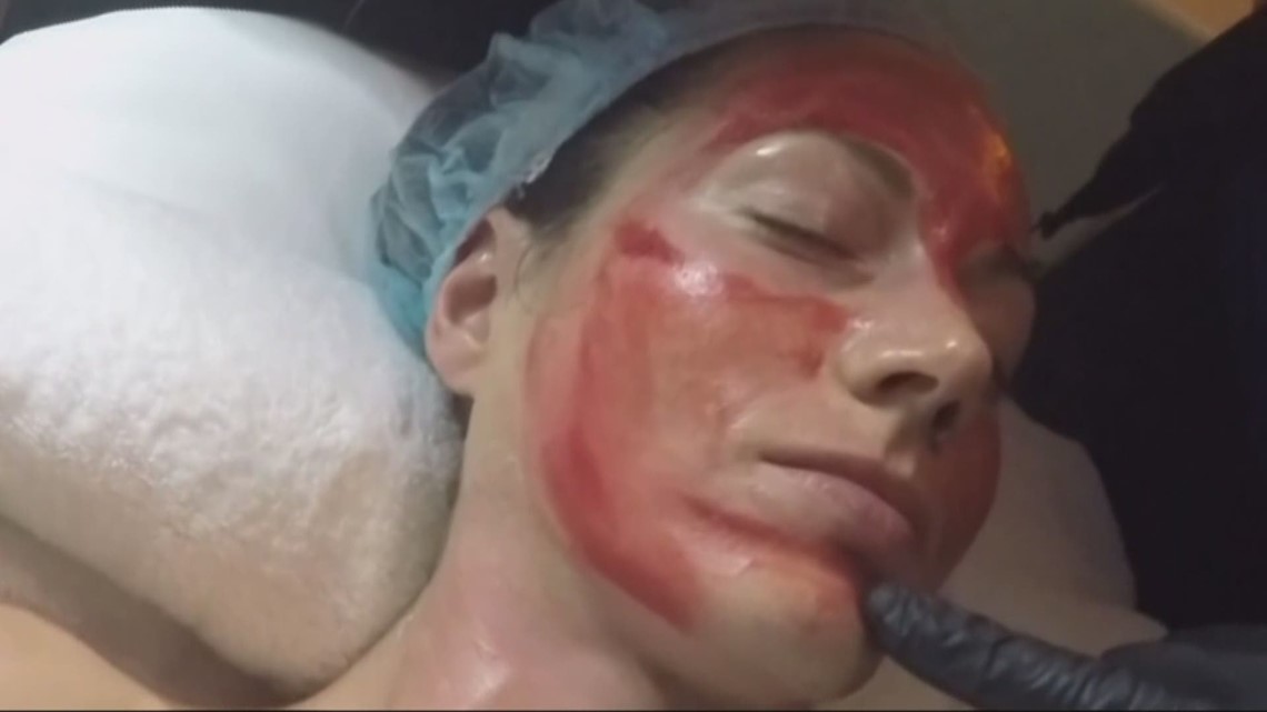 2 Diagnosed With Hiv After Vampire Facials At New Mexico Spa