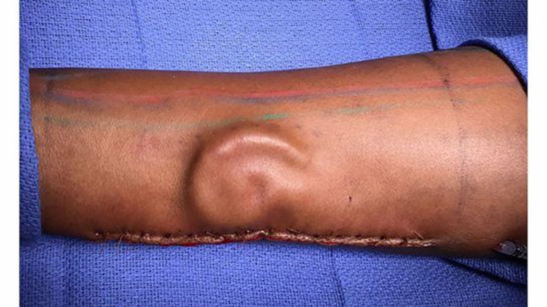 In what's being called a first of its kind surgery for the Army, doctors have successfully transplanted an ear 'grown' on a soldier's own forearm.