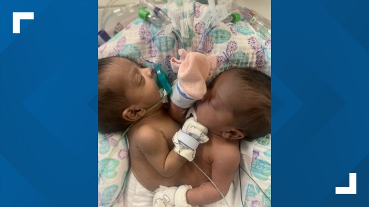 Conjoined twins successfully separated at North Texas hospital