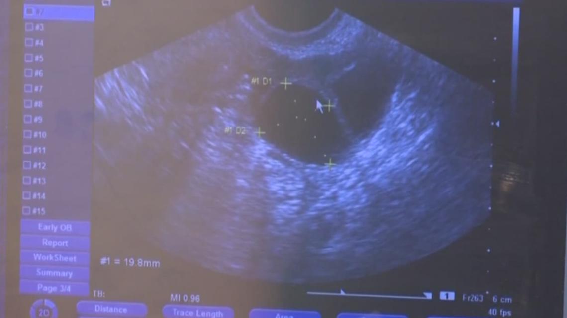 heartbeat bill texas